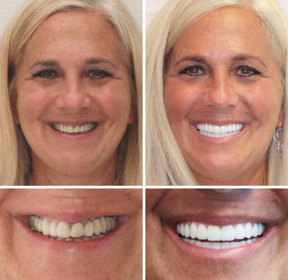 Smileasego™ - Premium Denture